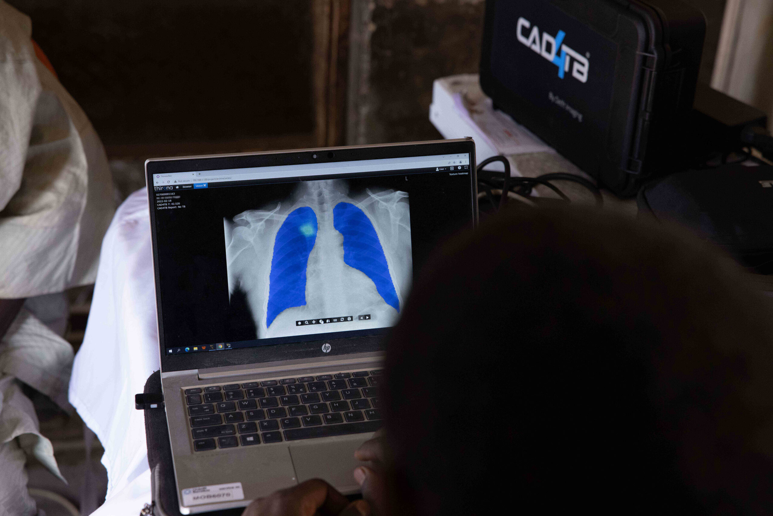 Radiographer is looking into CAD4TB platform to check the result