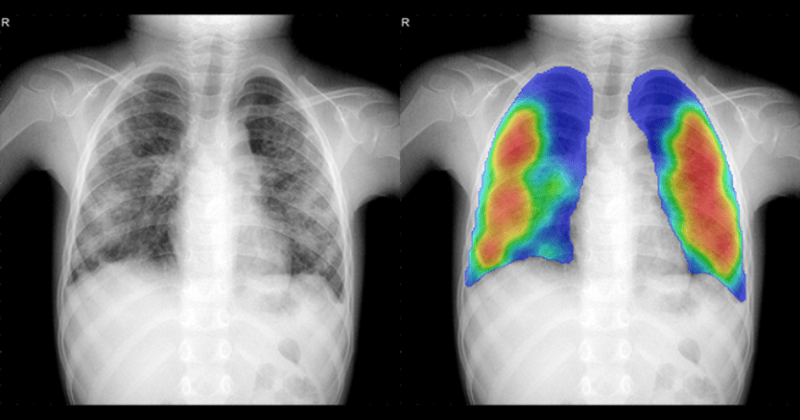 Chest X-ray image in CAD4TB of a child in Nigeria