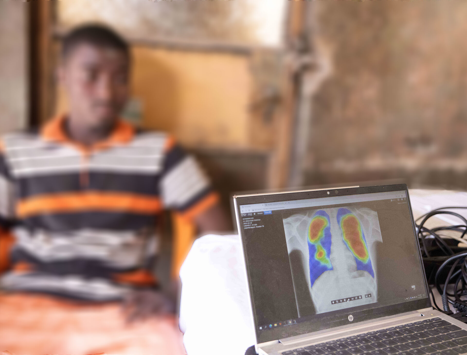 CAD4TB used in the filed in Nigeria with KNCV Nigeria