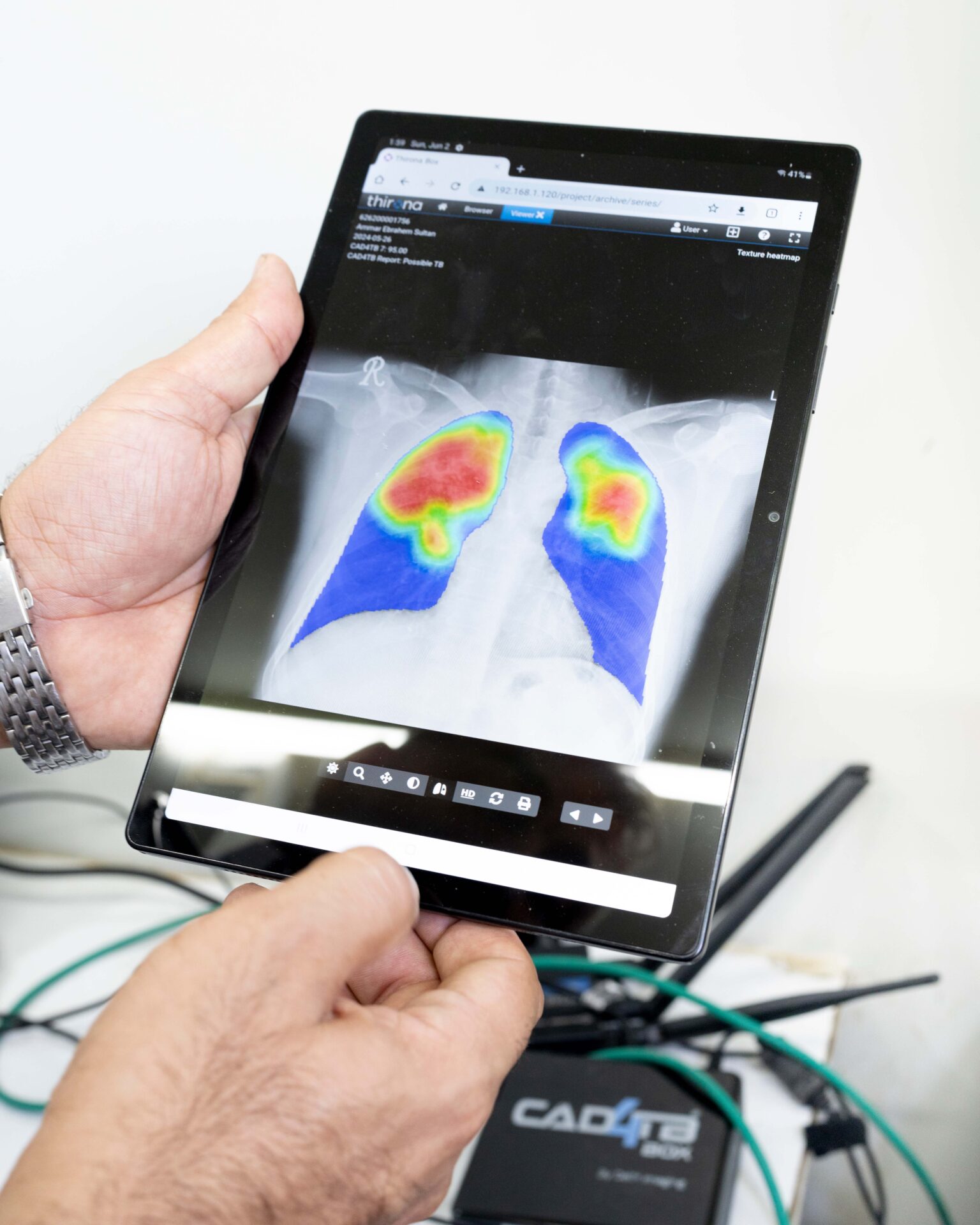 CAD4TB platform is being shown in Iraq