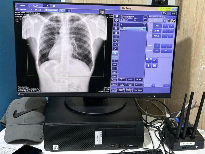 CAD4TB in Lamia Health Center in Gambia