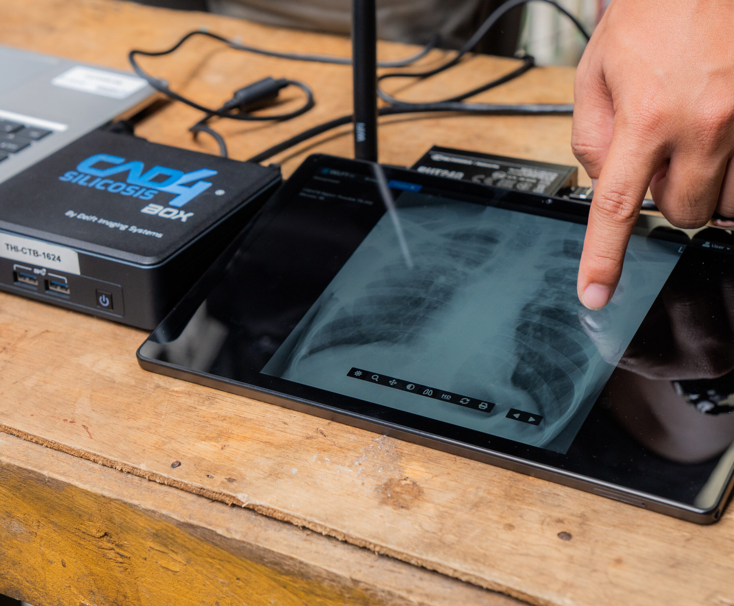 CAD4Silicosis in Philippines