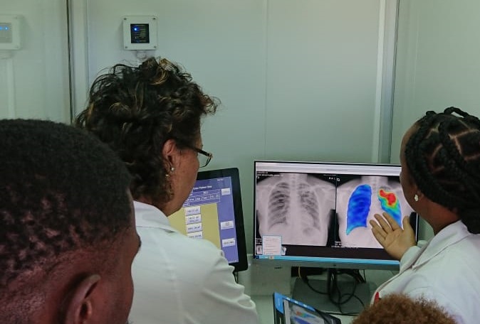 radiographers in Mozambique are looking at the CAD4TB screen