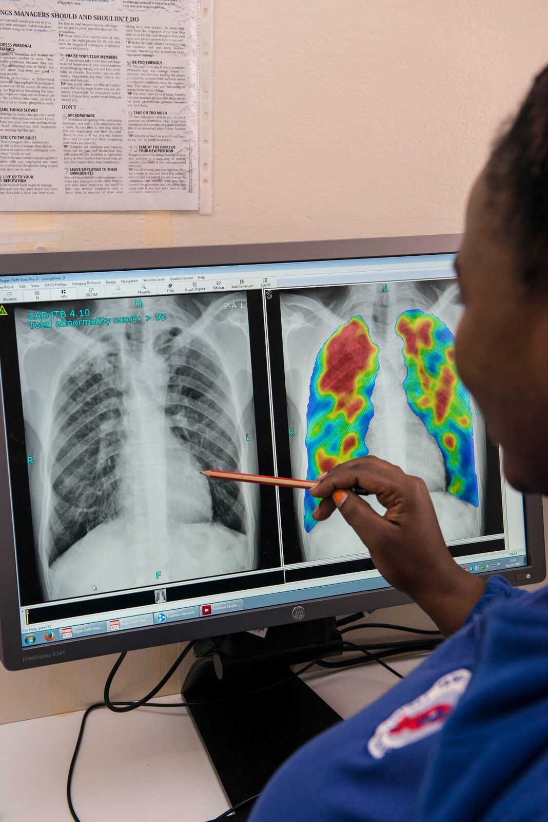 CAD4TB platform in South Africa